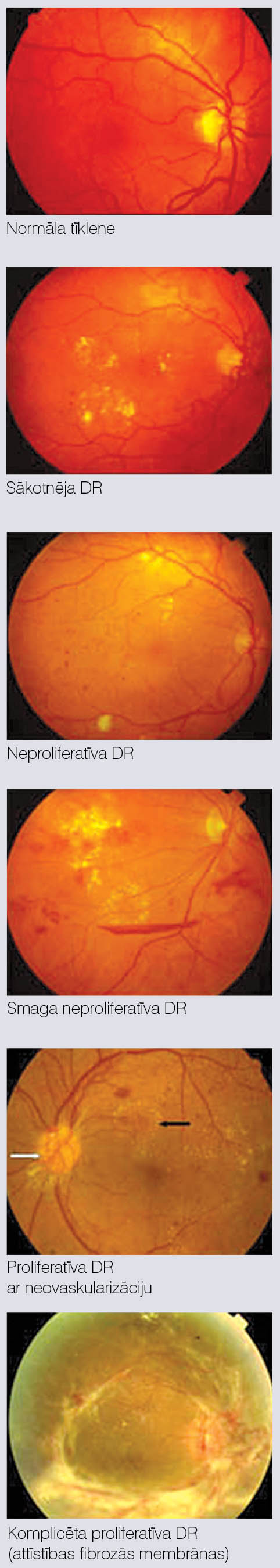 Diabētiskās retinopātijas  (DR) stadijas