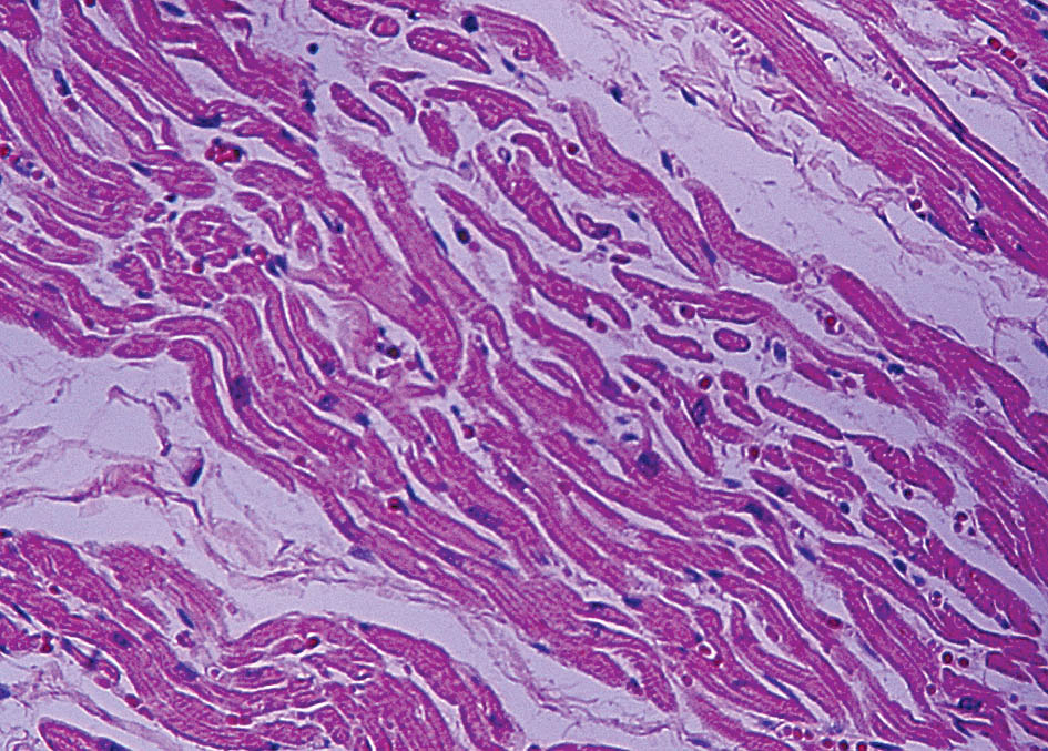 Miokarda intersticiālā tūska,  fibroze, perēkļveida stāze  (hematoksilīns—eozīns,  200 × palielinājums)