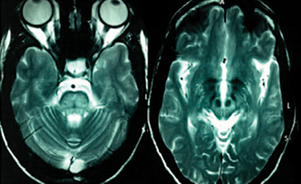 Vilsona slimībai raksturīgais  “trijžuburis” galvas smadzenēs
