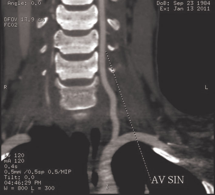 Paciente F., 1984. A. vertebralis disekcija  V–2 segmentā, C6—C5, C5—C4 starpskriemeļu spraugas ar nevienmērīgu lūmena sašaurinājumu,  ar angiogrāfijas verifikāciju