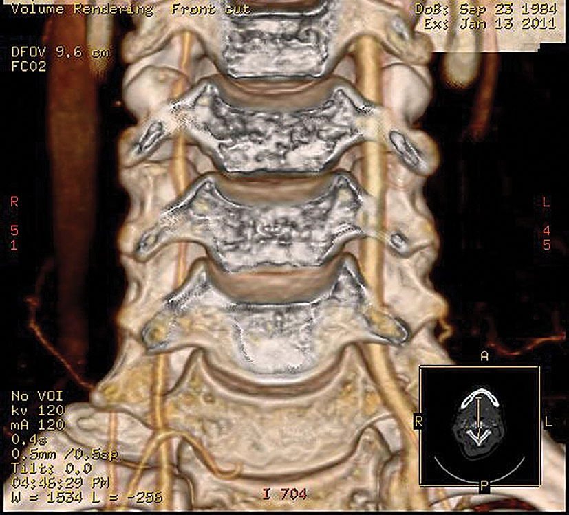 Paciente F., 1984. A. vertebralis disekcija  V–2 segmentā, C6—C5, C5—C4 starpskriemeļu spraugas ar nevienmērīgu lūmena sašaurinājumu,  ar angiogrāfijas verifikāciju