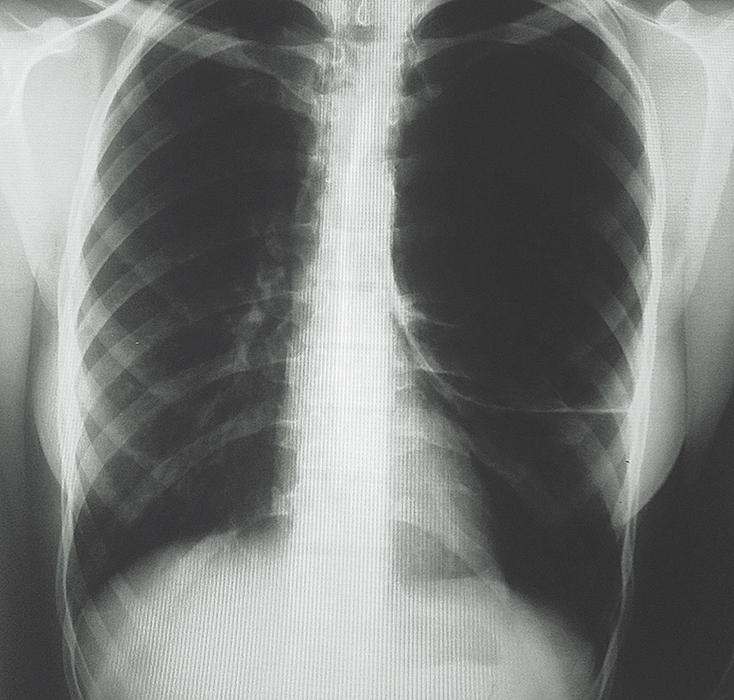 Krūškurvja rentgenogramma