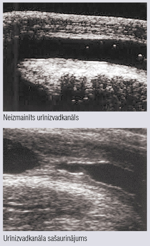 Urīnizvadkanāla ultrasonogrāfija