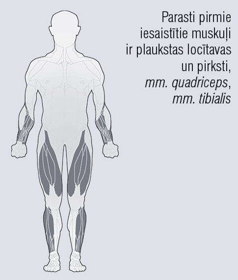 Pirmie iesaistītie muskuļi  ieslēguma ķermenīšu  miozīta gadījumā [4]