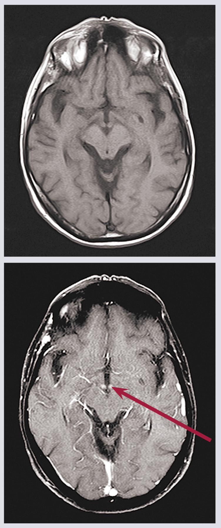 Aksiāli magnētiskās rezonanses attēli.  Paciente (54 gadi) ar Vernikes encefalopātiju,  malnutrīciju un kaheksiju. Pēc kontrastvielas  ievadīšanas redzama hiperintensitāte  Coprora mamillaria rajonā (bultiņa)