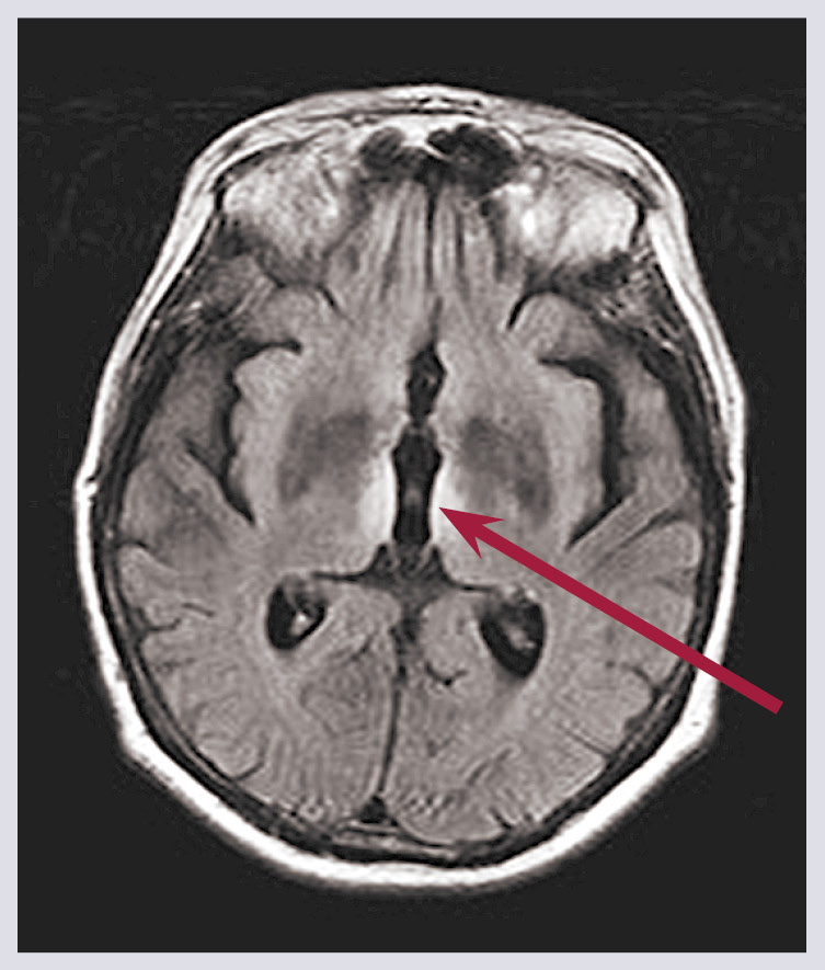 Vernikes encefalopātija.  Bilaterāla hiperintensitāte  mediālo talāma kodolu zonā  ar 3. ventrikula sieniņu involvāciju  (bultiņa)