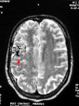 AVM labajā puslodē MRI izmeklējumā
