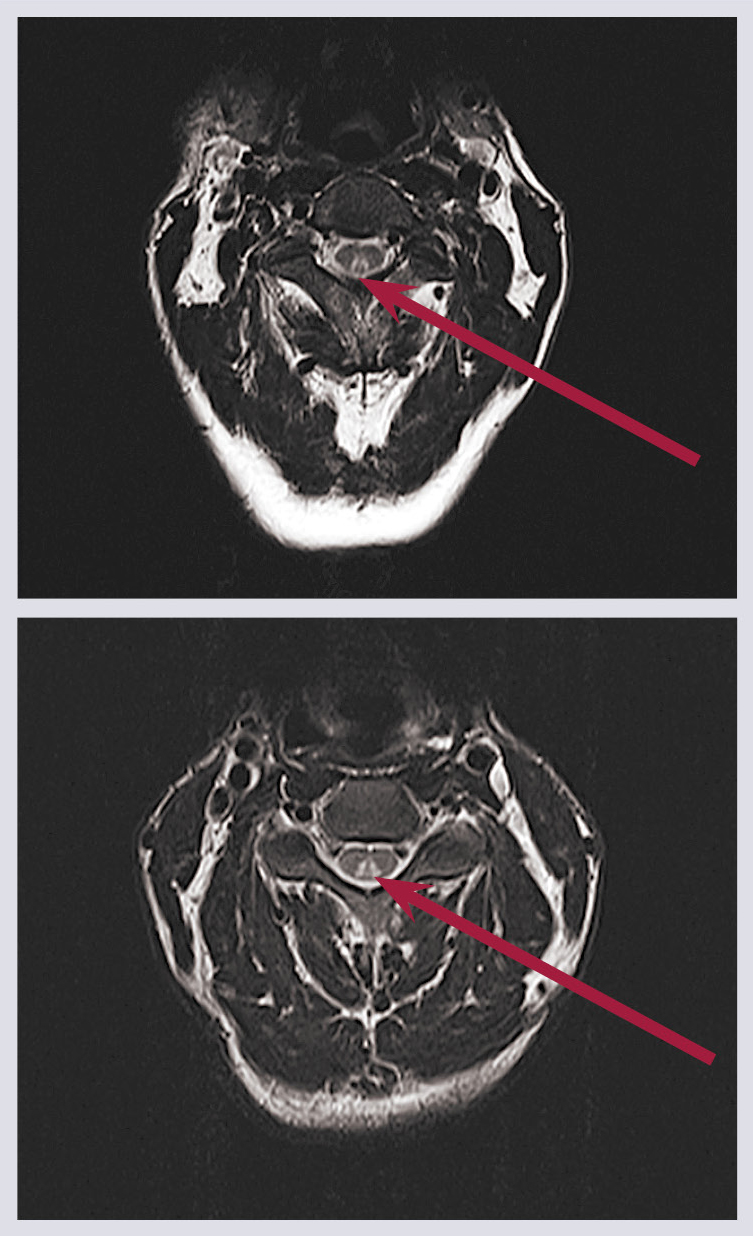 Aksiāli MR muguras smadzeņu attēli.  Vīrietis (47 gadi) ar funikulāro mielozi un anēmiju  B12 vitamīna trūkuma dēļ (autoimūns A tipa  gastrīts, malabsorbcijas sindroms). Nehomogēna  hiperintensitāte funiculus posterior zonā (bultiņa)