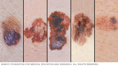 Neārstēta miega apnoja saistīta ar melanomas agresivitāti