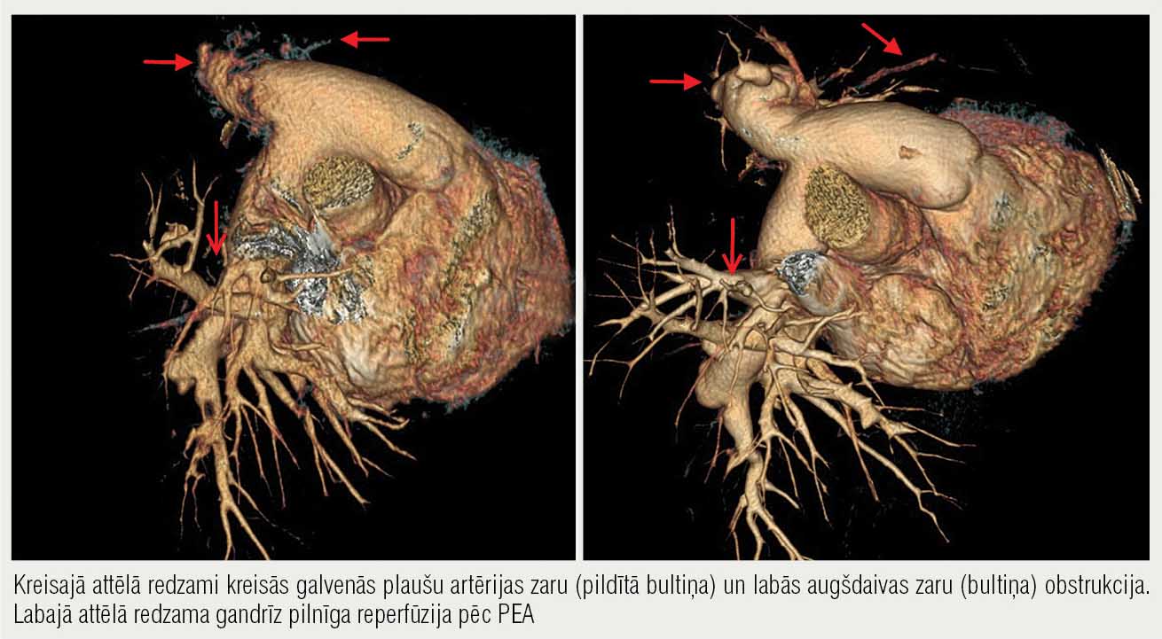 Sirds un plaušu artēriju 3D rekonstrukcijas attēls veidots no DT ar kontrastvielu  31 gadu jaunai sievietei pirms (pa kreisi) un pēc (pa labi) pulmonālās endarterektomijas (PEA)