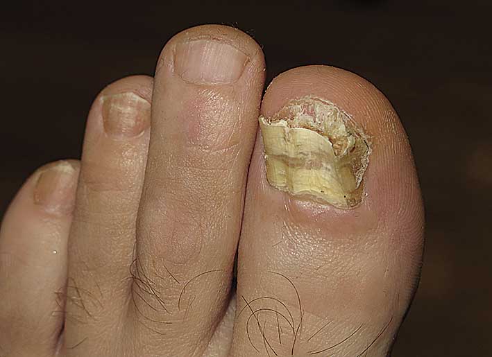 38 gadus vecs pacients  ar totālu kreisās kājas  īkšķa naga  onihomikotisku bojājumu