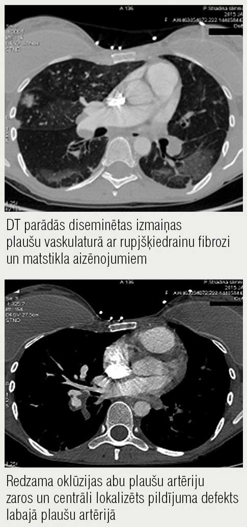 Krūškurvja DT ar kontrastvielu  (aksiālā plakne) 31 gadu  jaunai sievietei pirms pulmonālās  endarterektomijas