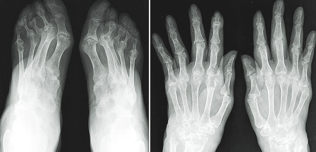 Pēdu un plaukstu rentgenogrammas