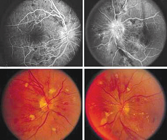 Hipertensīva retinopātija.  Liesmveidīgas hemorāģijas,  viegla eksudācija,  agrīna diska miglošanās