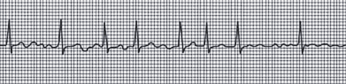 EKG pacientam ar PM
