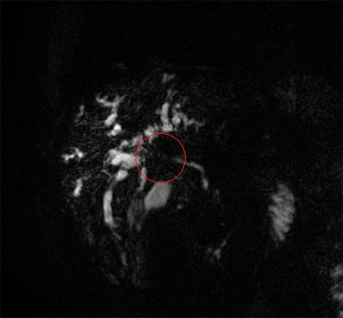 Perihilāra holangiokarcinoma,  4. tips pēc Bismuth—Corlette  (MRCP attēls; no “Gaiļezers”  Diagnostiskās radioloģijas  nodaļas arhīva). Kontrastvielas pildījuma defekts iesniedzas abu aknu daivu žultsvados, bifurkācijas līmenis nav vizualizējams