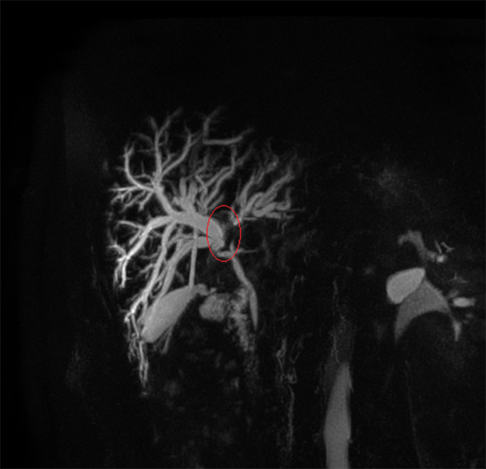 Perihilāra holangiokarcinoma,  3. B tips pēc Bismuth—Corlette  (MRCP attēls; no “Gaiļezers”  Diagnostiskās radioloģijas  nodaļas arhīva). Paplašināti intrahepatiskie žultsvadi proksimāli no aknu žultsvadu saplūšanas vietas; kontrastvielas pildījuma defekt