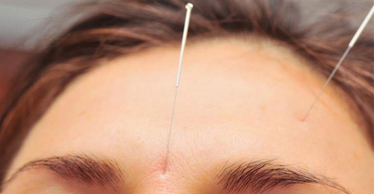 Akupunktūra migrēnas profilaksei