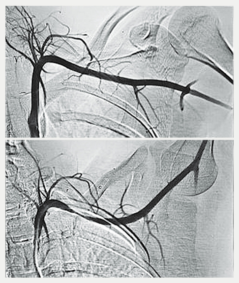 Digitālās angiogrāfijas metode  ar pozitīvu thoracic outlet  sindromu a. subclavia