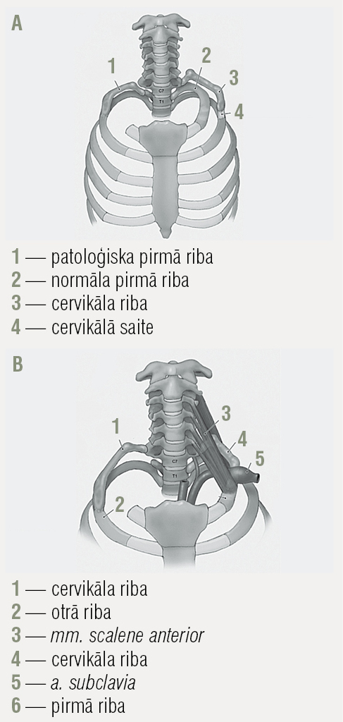 TOS biežākais cēlonis:  anatomiski izmainīta riba (A),  kakla riba (B)