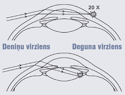 Perifērā UV staru  fokusa veidošanās shēma [6]