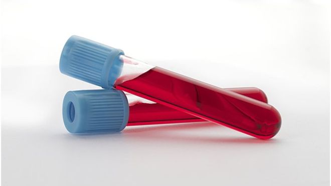 HPV testēšana ir efektīvāka nekā citoloģiskā uztriepe dzemdes kakla vēža atklāšanā