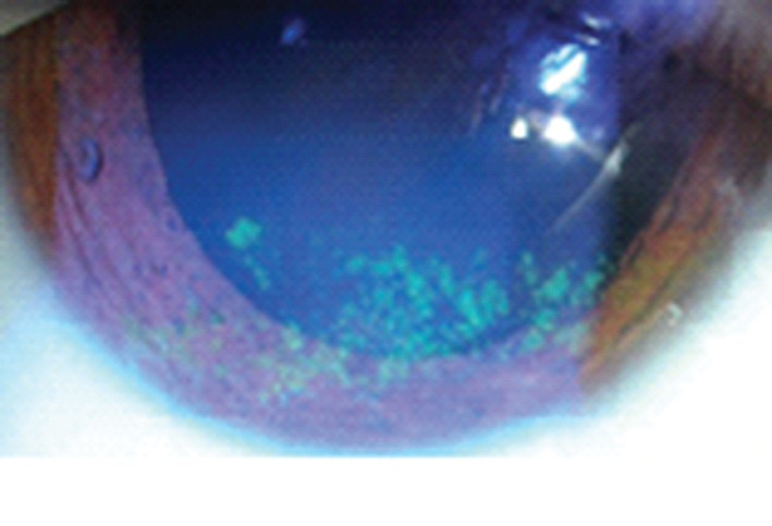 Punktveida epiteliāli  defekti radzenē,  kas krāsojas ar fluorescīnu [6]