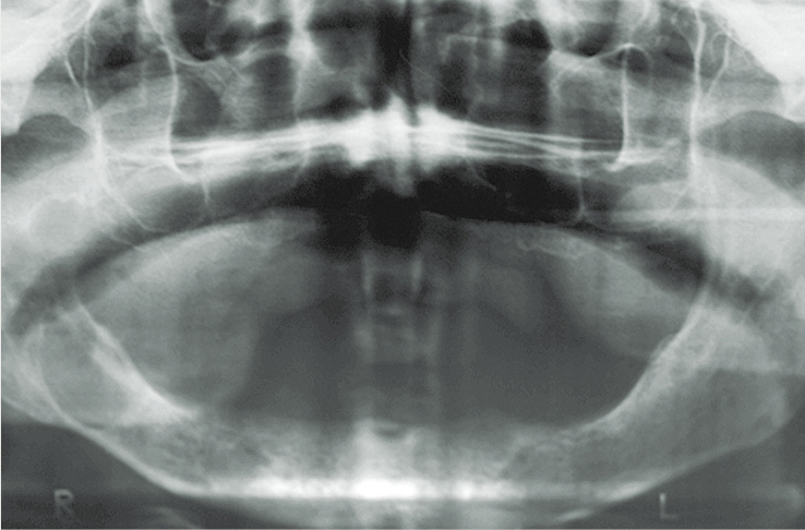 Pacienta ortopantomogramma pirms cistektomijas