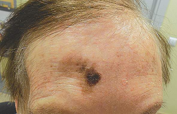 Lentigo maligna melanoma. Terapijas iespējas