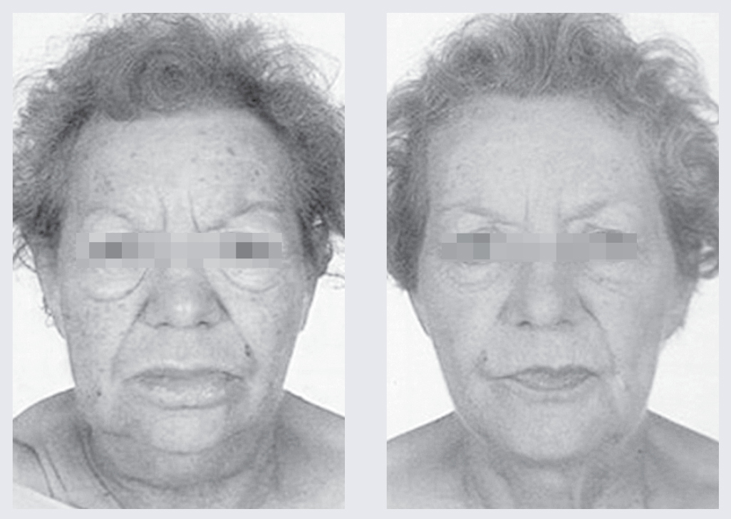Paciente ar hipotireozi pirms un pēc ārstēšanas.  Novērtējiet izteikti pastozu seju, apātisku sejas izteiksmi,  sausus, nepakļāvīgus matus