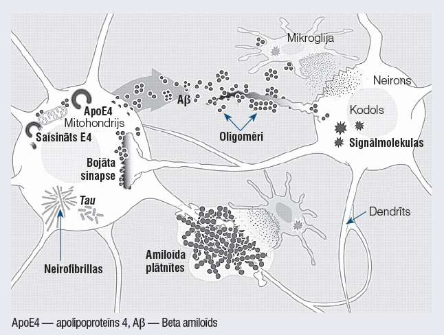 Ekstracelulārās amiloīda plātnītes un intracelulārās neirofibrillas  Alcheimera slimības gadījumā [8]