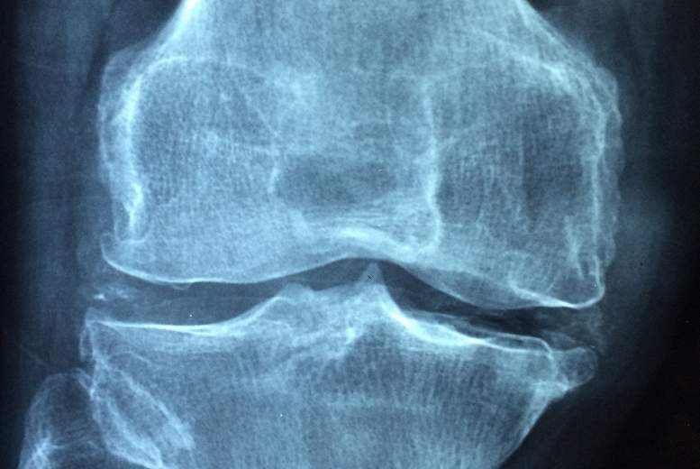 Statīnu lietošana saistīta ar samazinātu osteoprozes un sekojošu lūzumu risku pacientiem pēc insulta