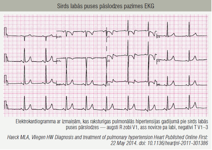Sirds labās puses pāslodzes pazīmes EKG