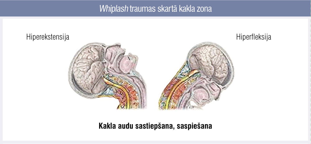 Whiplash traumas skartā kakla zona