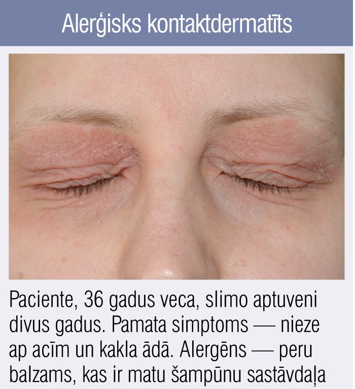 Alerģisks kontaktdermatīts
