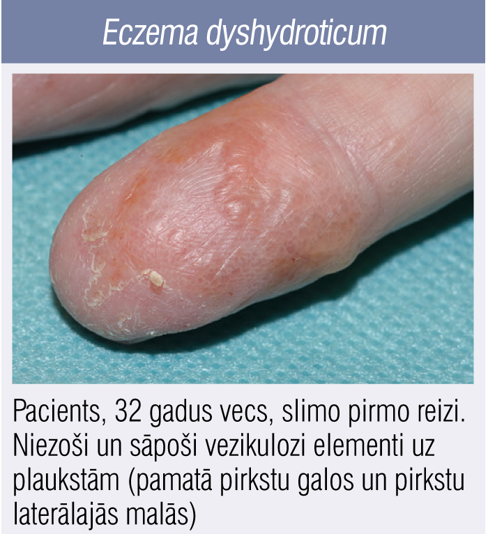 Eczema dyshydroticum