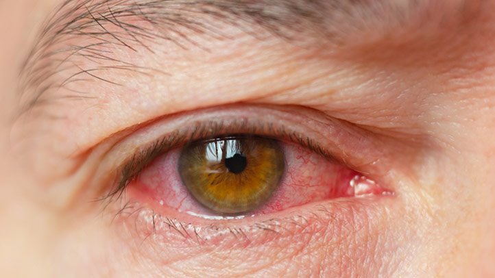 Blakus saslimšanas un izrakstītie medikamenti pacientiem ar un bez sausās acs sindroma
