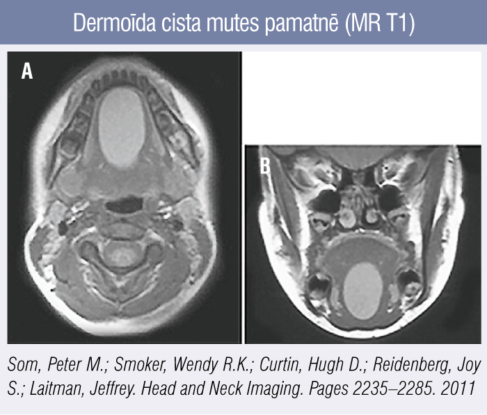 Dermoīda cista mutes pamatnē (MR T1)