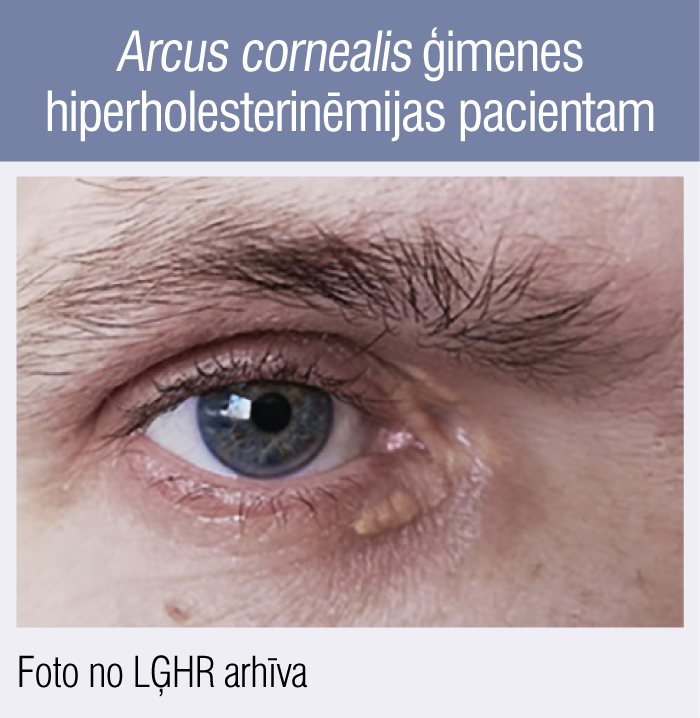 Arcus cornealis ģimenes hiperholesterinēmijas pacientam
