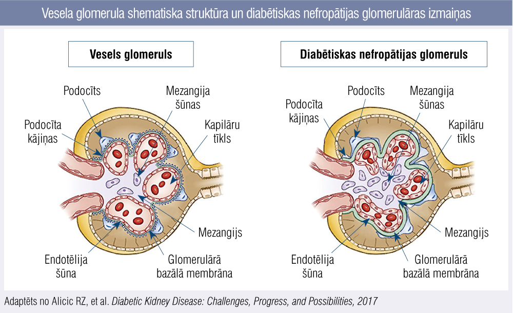 Vesela glomerula shematiska struktūra un diabētiskas nefropātijas glomerulāras izmaiņas
