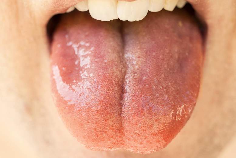 Dedzinošas mutes sindroms. Izmainītas siekalu plūsmas nozīme