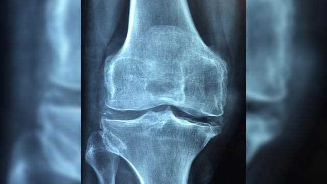 Osteoartrīts saistīts ar augstāku kardiovaskulārās mirstības risku