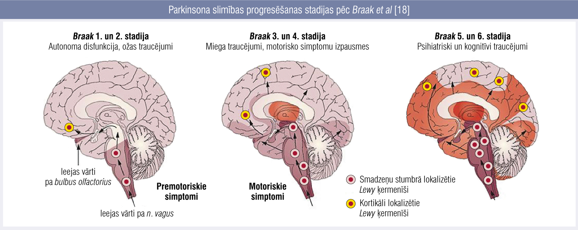 Parkinsona slimības progresēšanas stadijas pēc Braak et al [18]