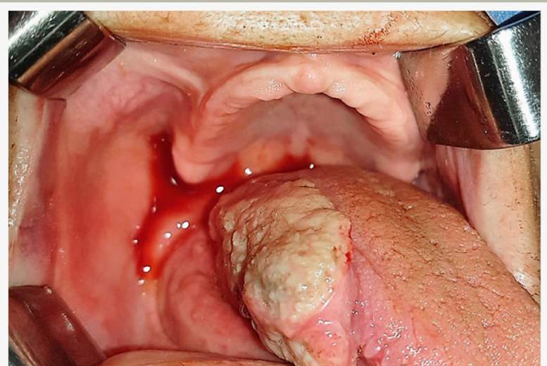Mutes dobuma audzējs. Savlaicīga diagnostika — veiksmīgs rezultāts