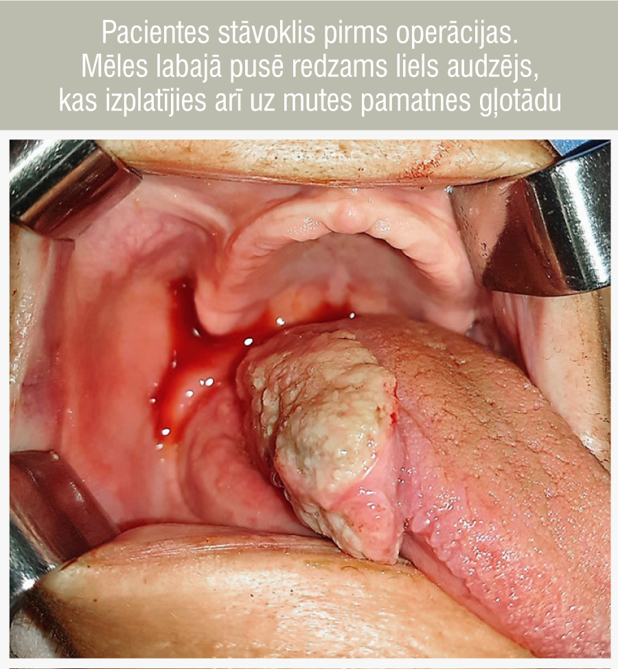 Pacientes stāvoklis pirms operācijas. Mēles labajā pusē redzams liels audzējs, kas izplatījies arī uz mutes pamatnes gļotādu