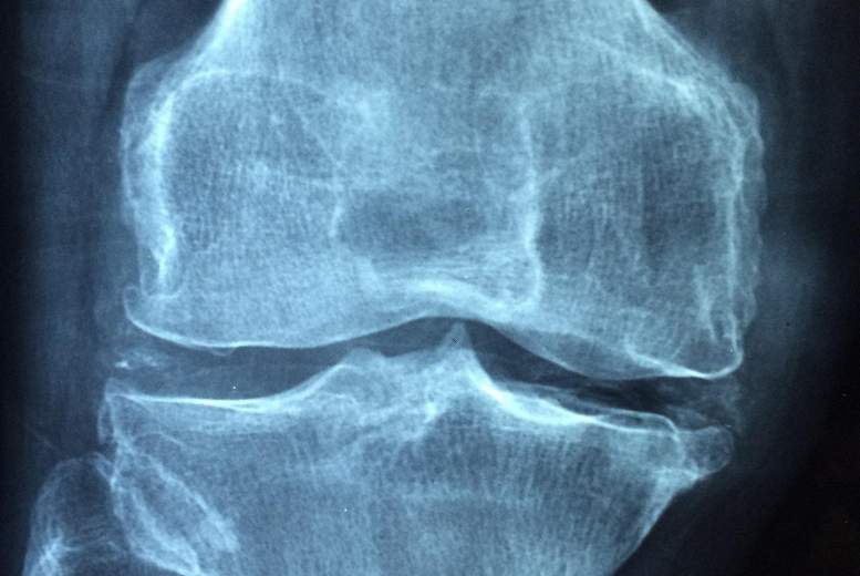 Osteopēnija. Vai osteoporoze ir novēršama?