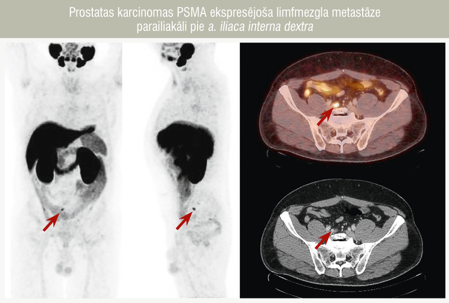 Prostatas karcinomas PSMA ekspresējoša limfmezgla metastāze parailiakāli pie a. iliaca interna dextra