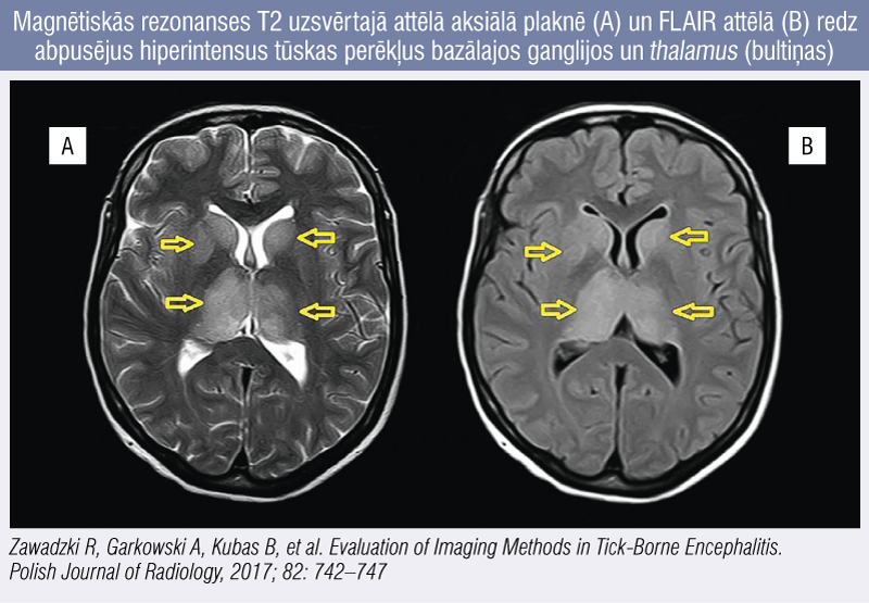 Magnētiskās rezonanses T2 uzsvērtajā attēlā aksiālā plaknē (A) un FLAIR attēlā (B) redz abpusējus hiperintensus tūskas perēkļus bazālajos ganglijos un thalamus (bultiņas)