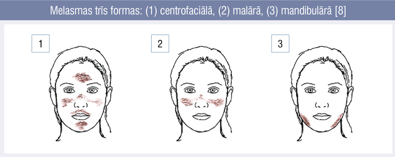 Melasmas trīs formas: (1) centrofaciālā, (2) malārā, (3) mandibulārā [8]