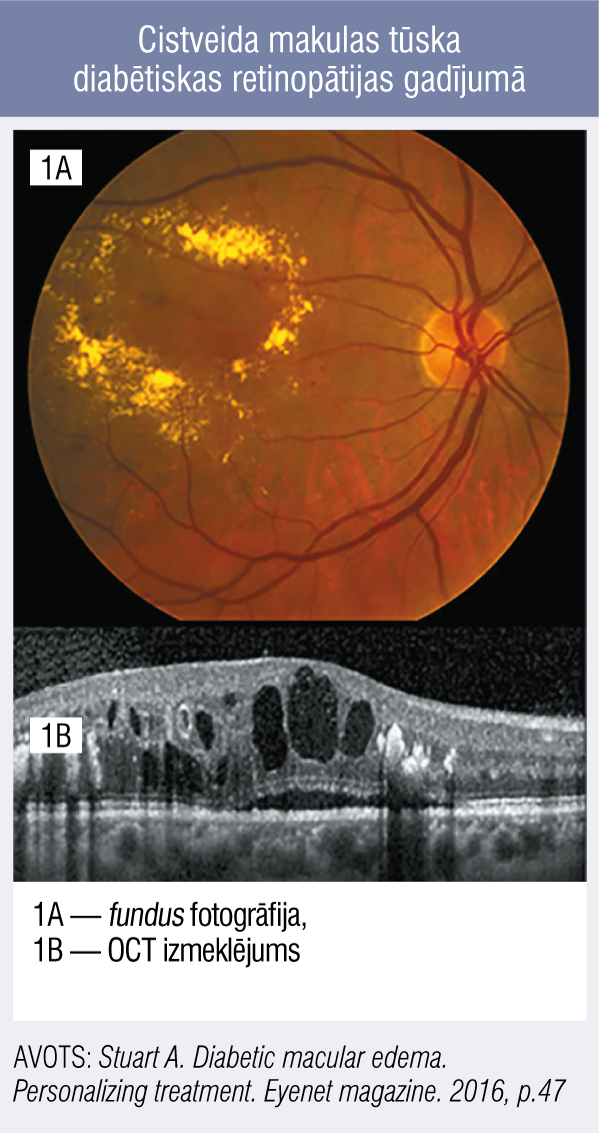 Cistveida makulas tūska diabētiskas retinopātijas gadījumā